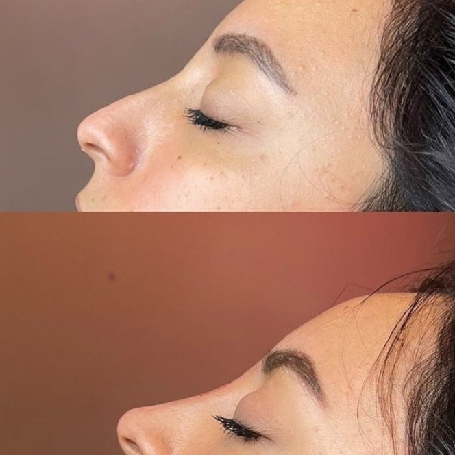 Before and after profile comparison showing facial contouring results