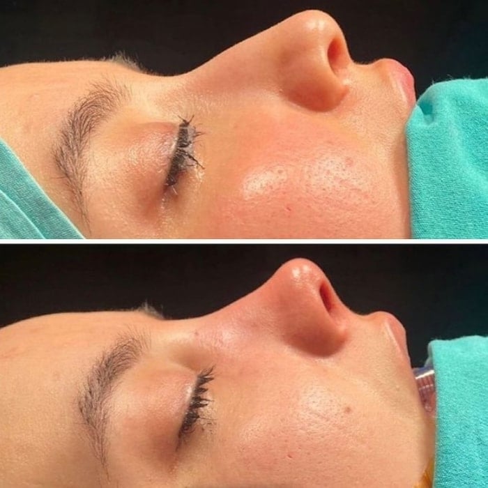 Before and after comparison of facial skin treatment on cheek and jawline area