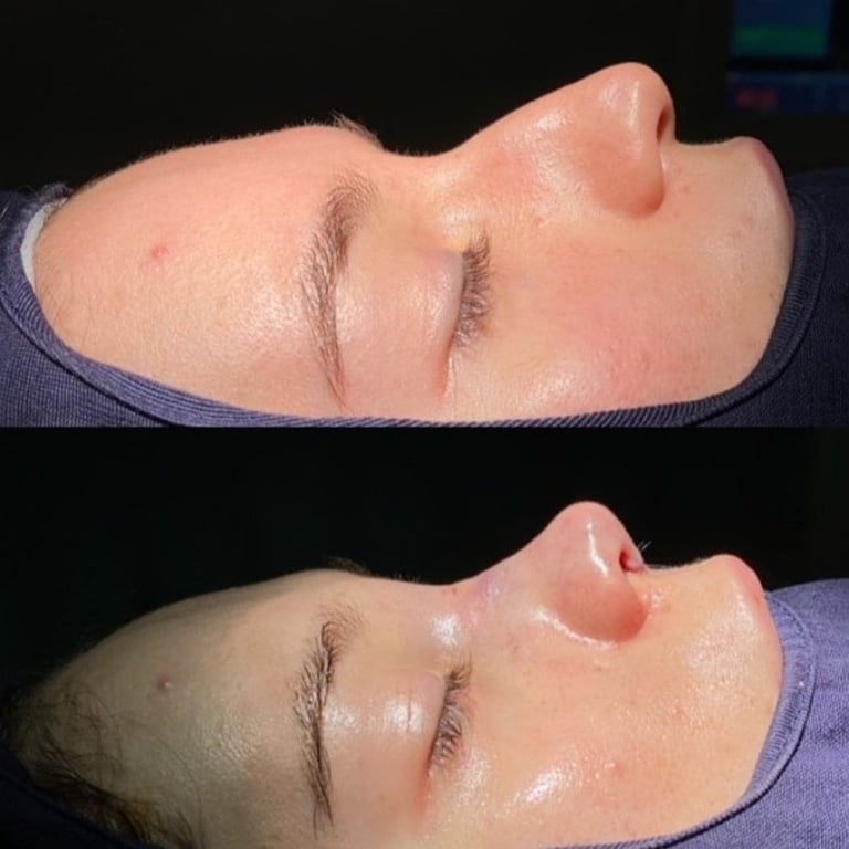 Before and after comparison of facial profile showing cosmetic enhancement