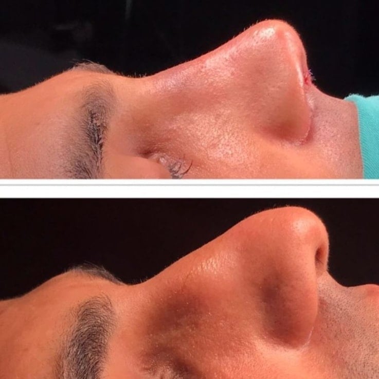 Before and after comparison of chin augmentation