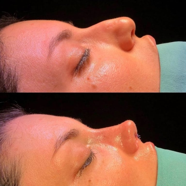 Before and after side profile comparison showing facial treatment results